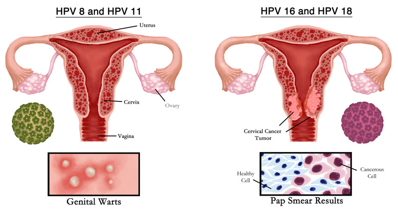 HPV Types