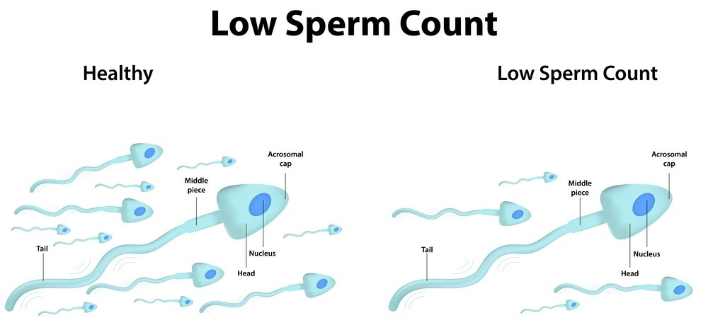 male infertility low sperm count