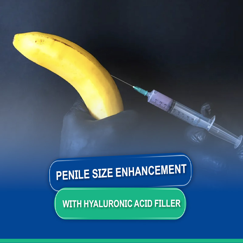 Penile Size Enhancement with Hyaluronic Acid Filler