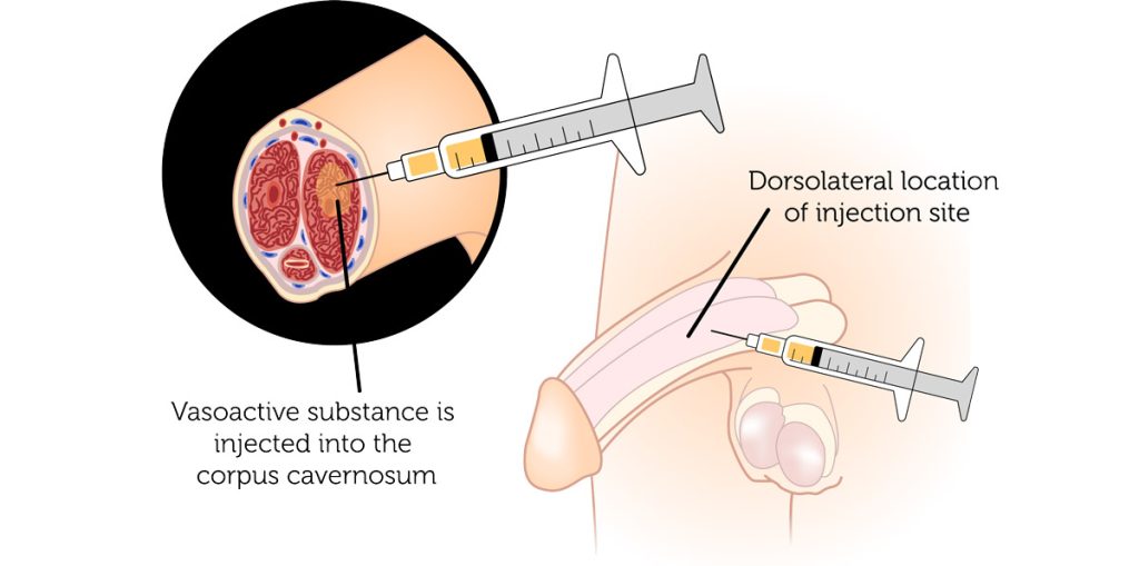 Stem Cell injection