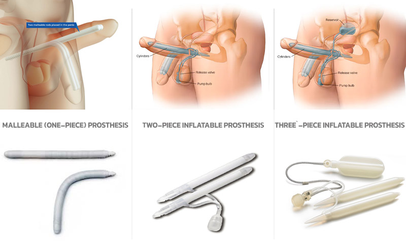 Penile Implants