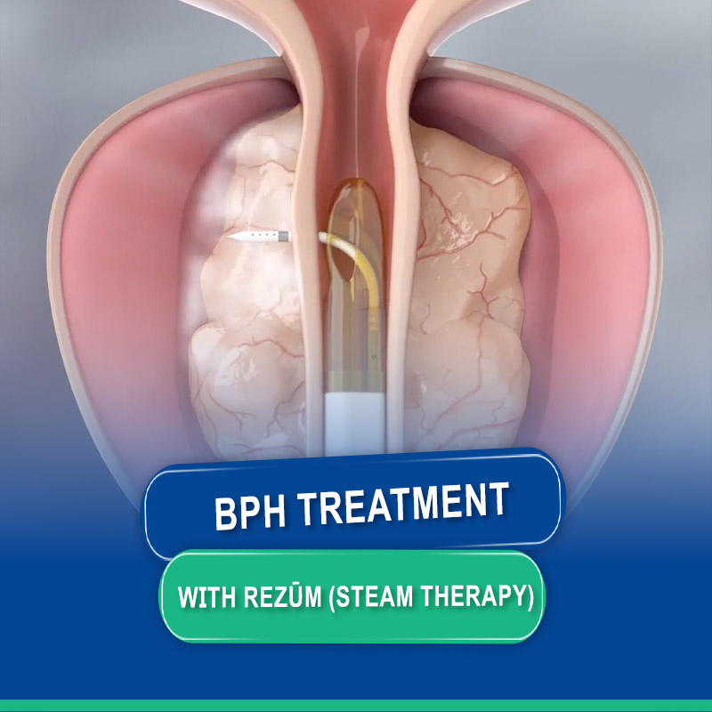 BPH Treatment with Rezūm (Steam Therapy)