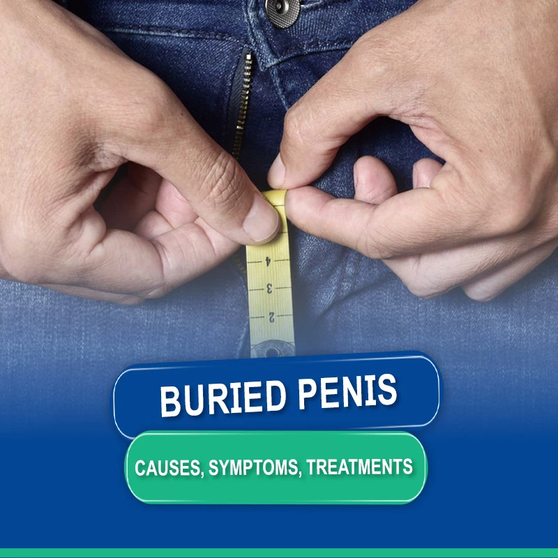Buried Penis