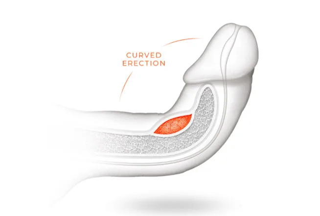 Penile Deformity