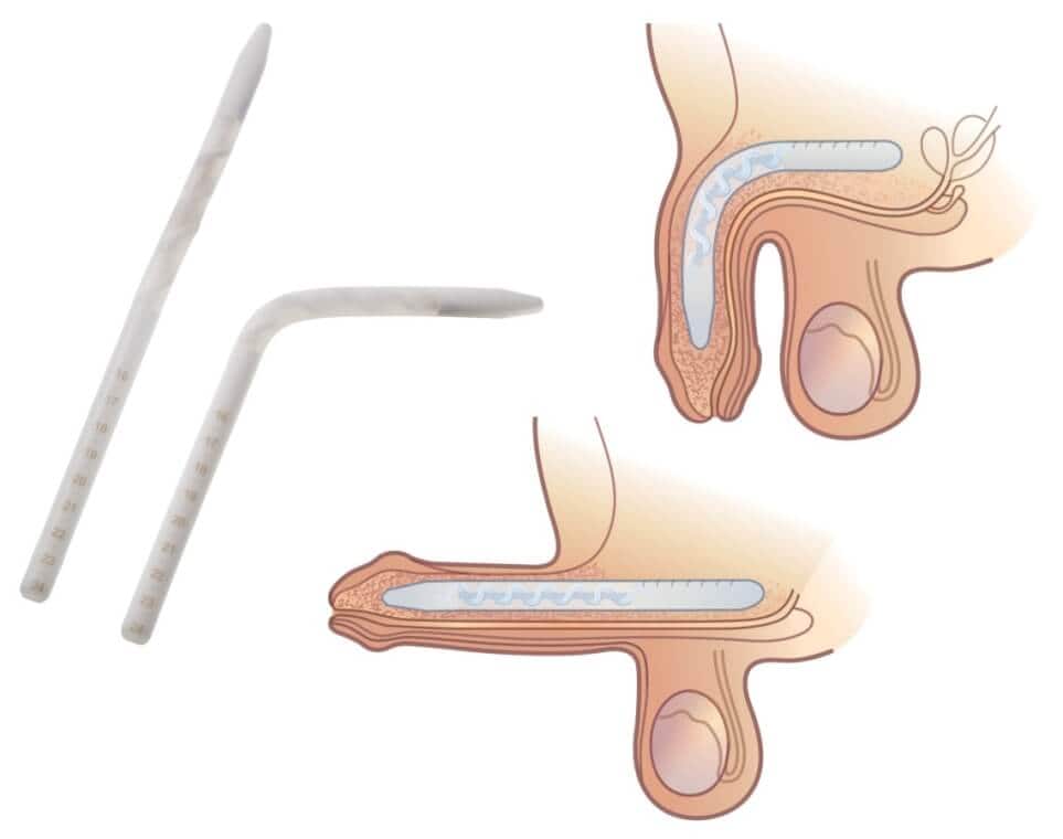 Semirigid (Non-Inflatable) Penile Implants