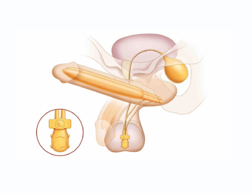 Three Piece Penile Implantt