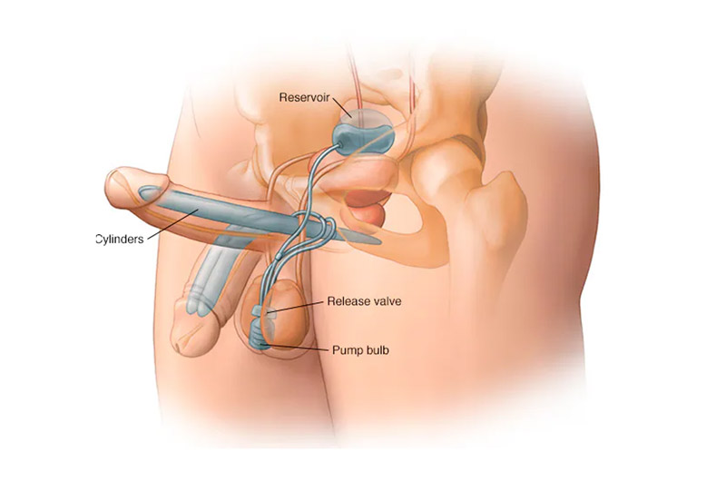 what is penile implant