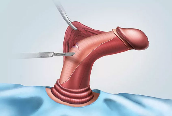 Congenital Penile Curvature