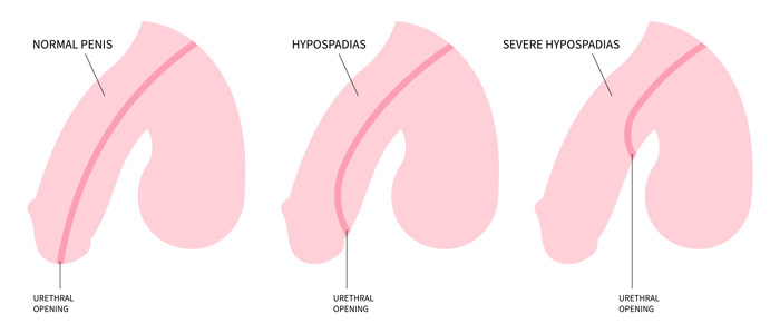 Hypospadias Deformity