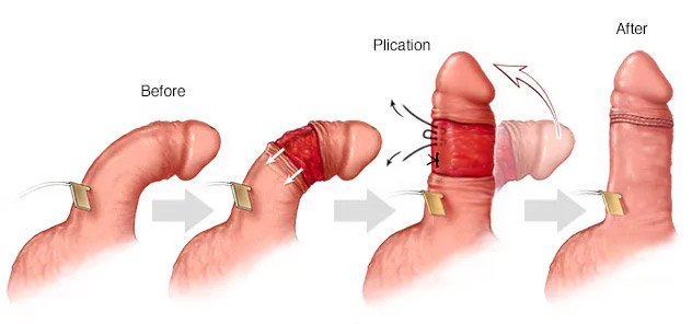 Penile Plication Surgery