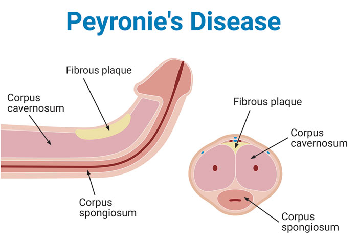 Peyronie’s Disease