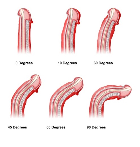 Penile Deformity Degree
