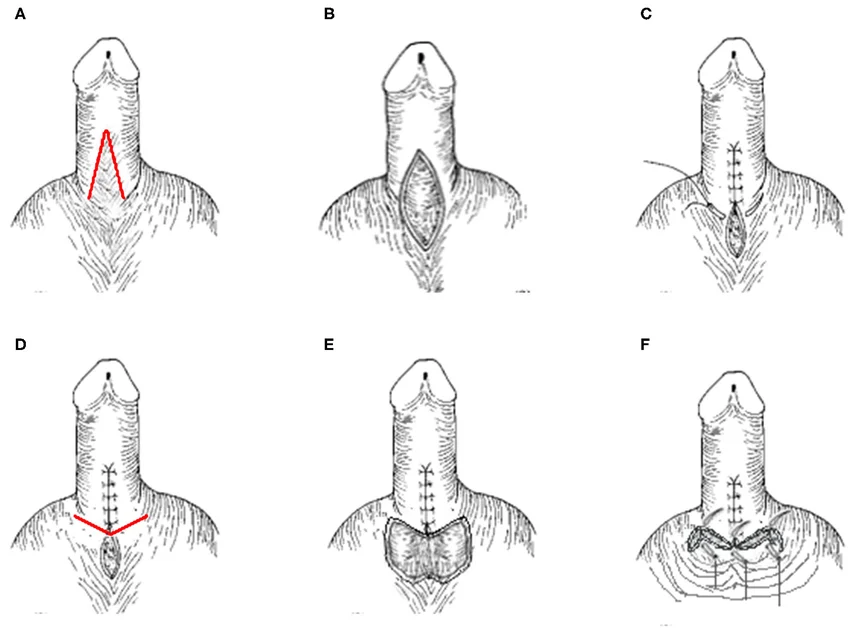 Inverted V-Y Plasty and Local Skin Techniques