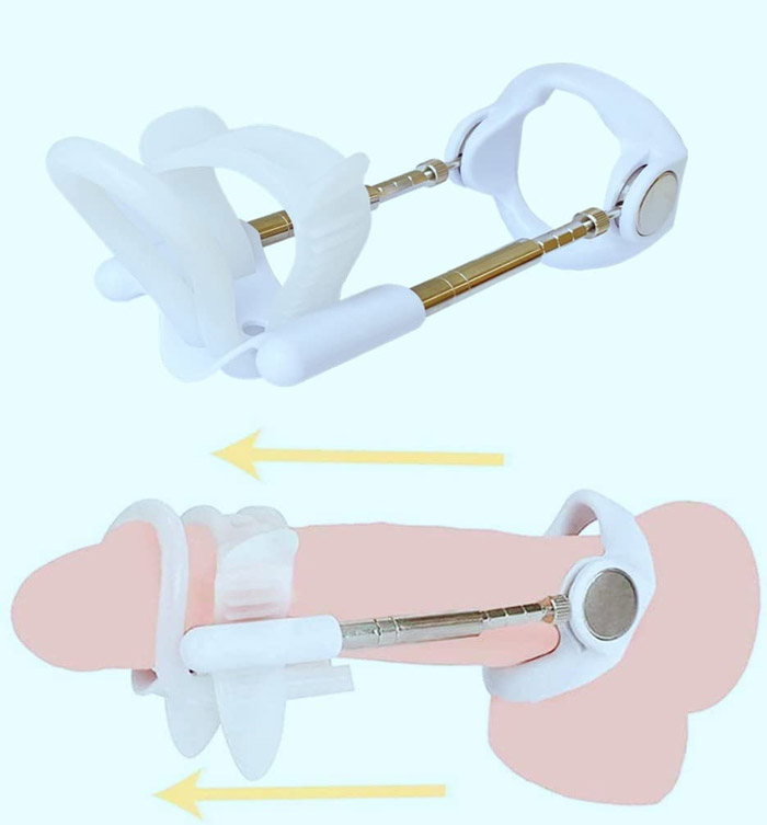 Penile Stretching and Traction Devices