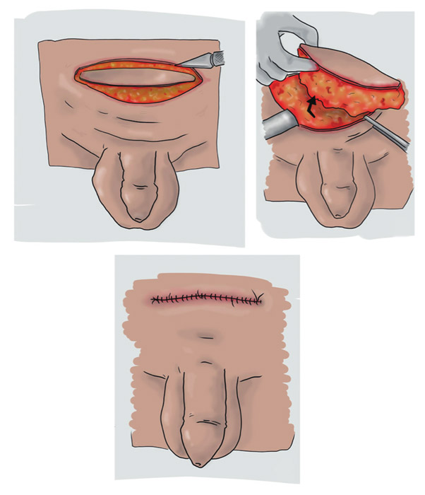 Suprapubic Lipectomy: Removing Fat That Hides the Penis