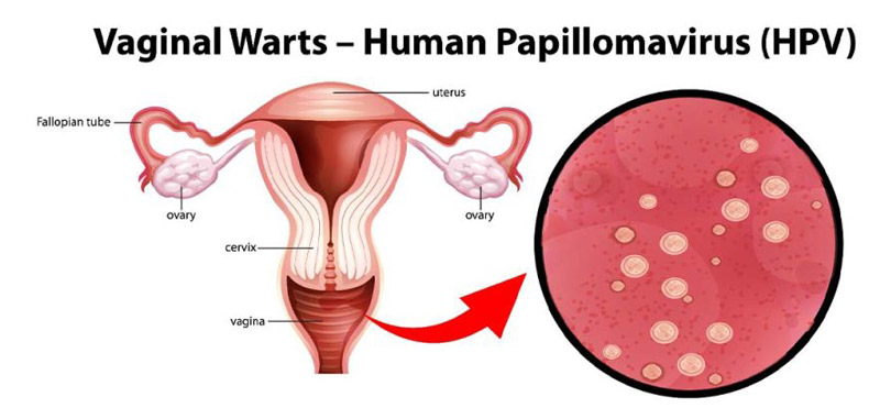 Vaginal Warts