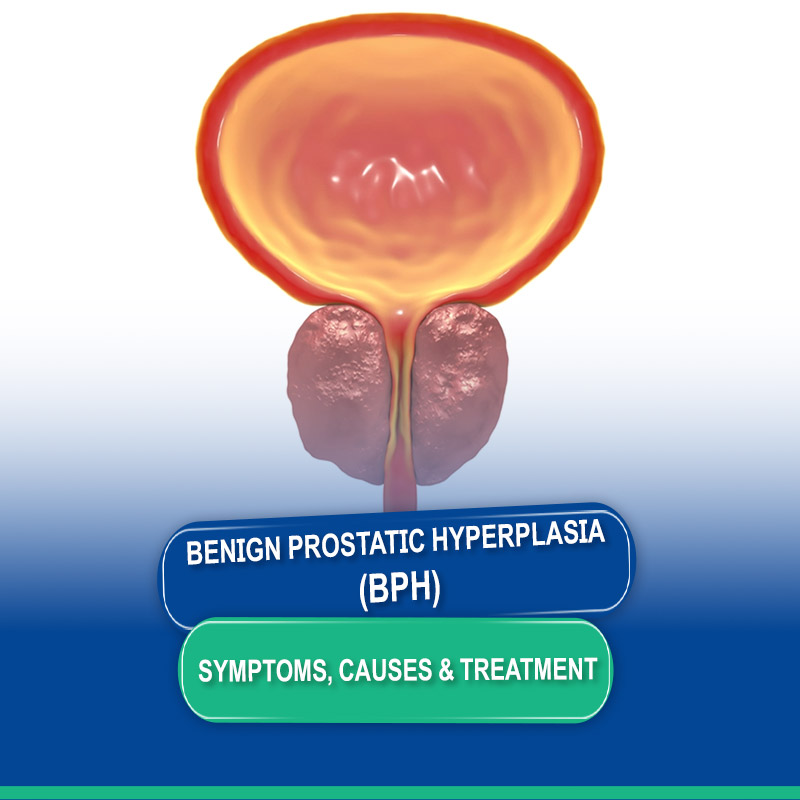 Benign Prostatic Hyperplasia (BPH): Symptoms, Causes, Diagnosis & Treatment