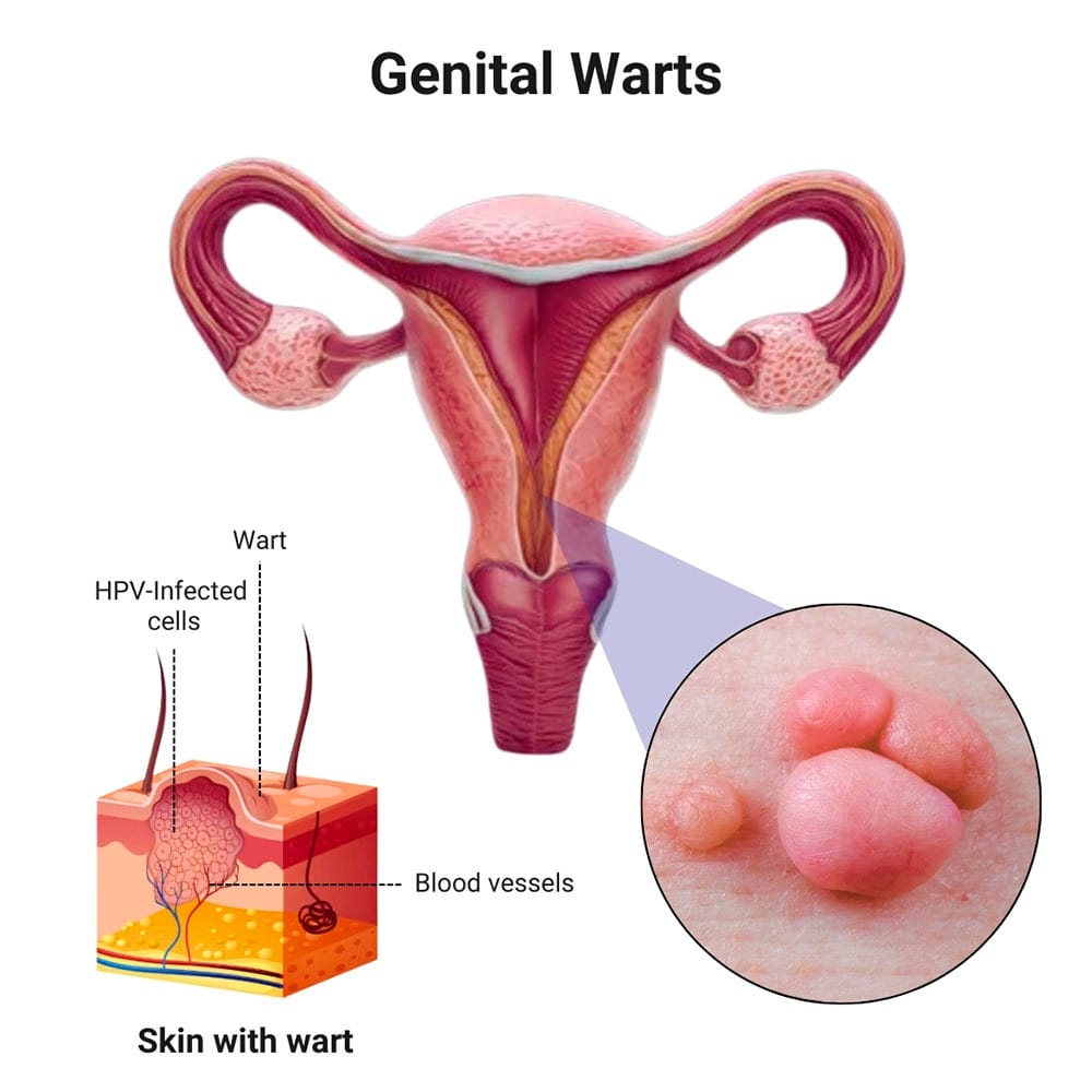genital warts in females