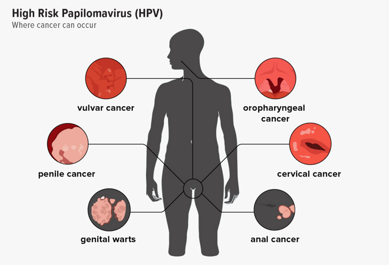 HPV and Cancer Risk