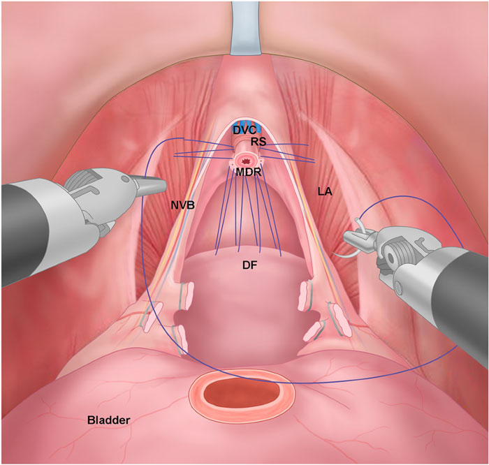 Laparoscopic or robotic prostatectomy