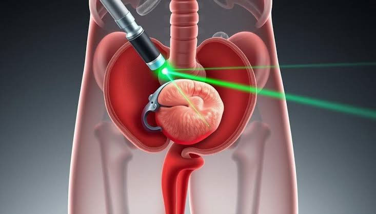 Laser prostate surgery