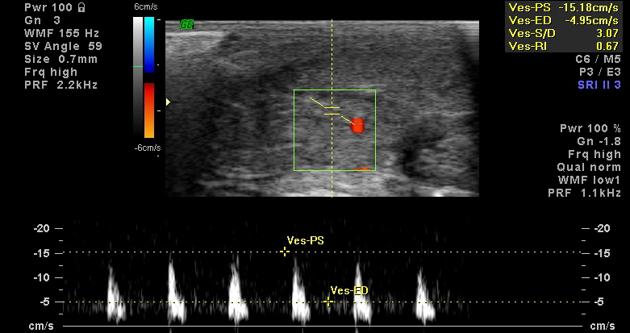 Penile Color Doppler Ultrasound
