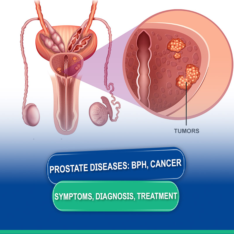 Prostate Diseases and Treatment