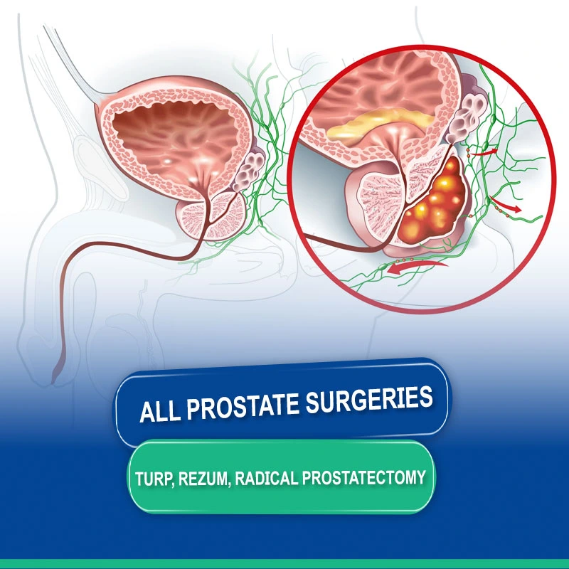 Prostate Surgeries: TURP, Rezum, Open Prostatectomy, and Radical Prostatectomy