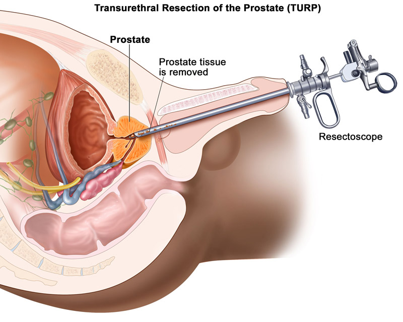 TURP / prostate shaving